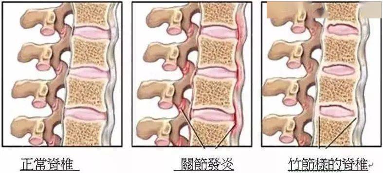 美國強(qiáng)直性脊柱炎最新研究進(jìn)展，影響與展望